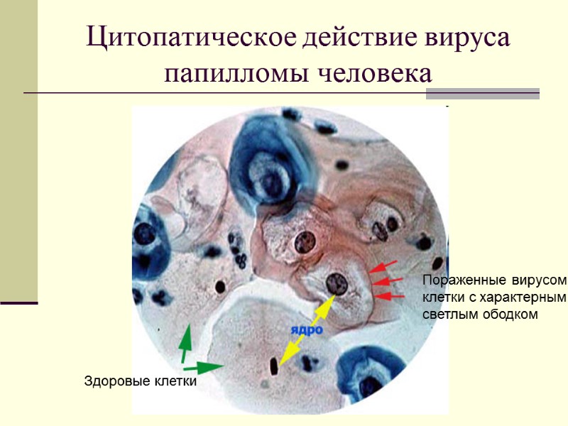Цитопатическое действие вируса папилломы человека Здоровые клетки Пораженные вирусом  клетки с характерным светлым